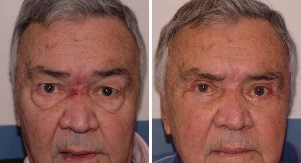 Case 13219 - blepharoplasty