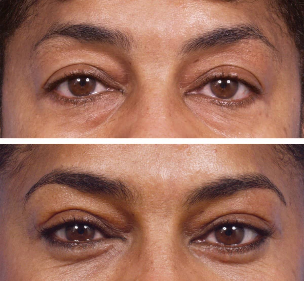 Case 13220 - blepharoplasty