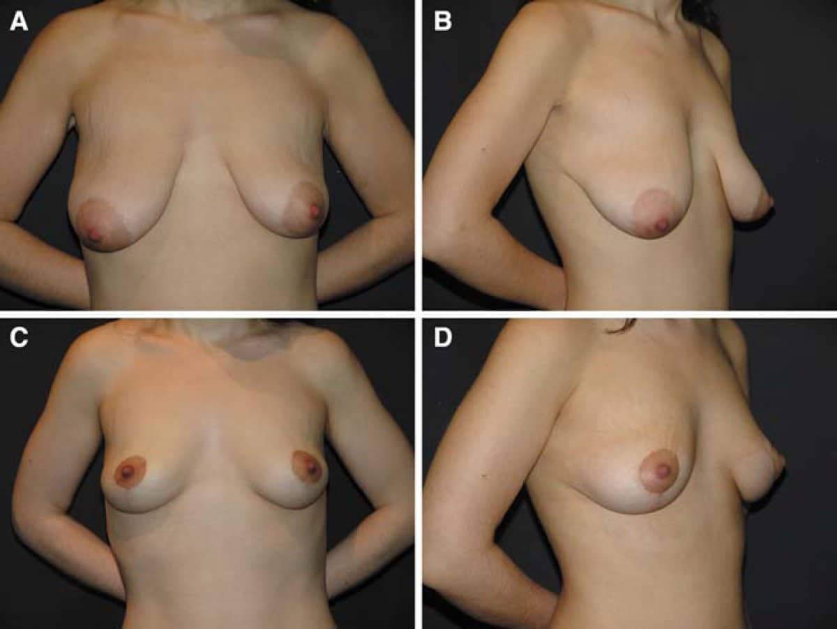 Case 13221 - breast lift