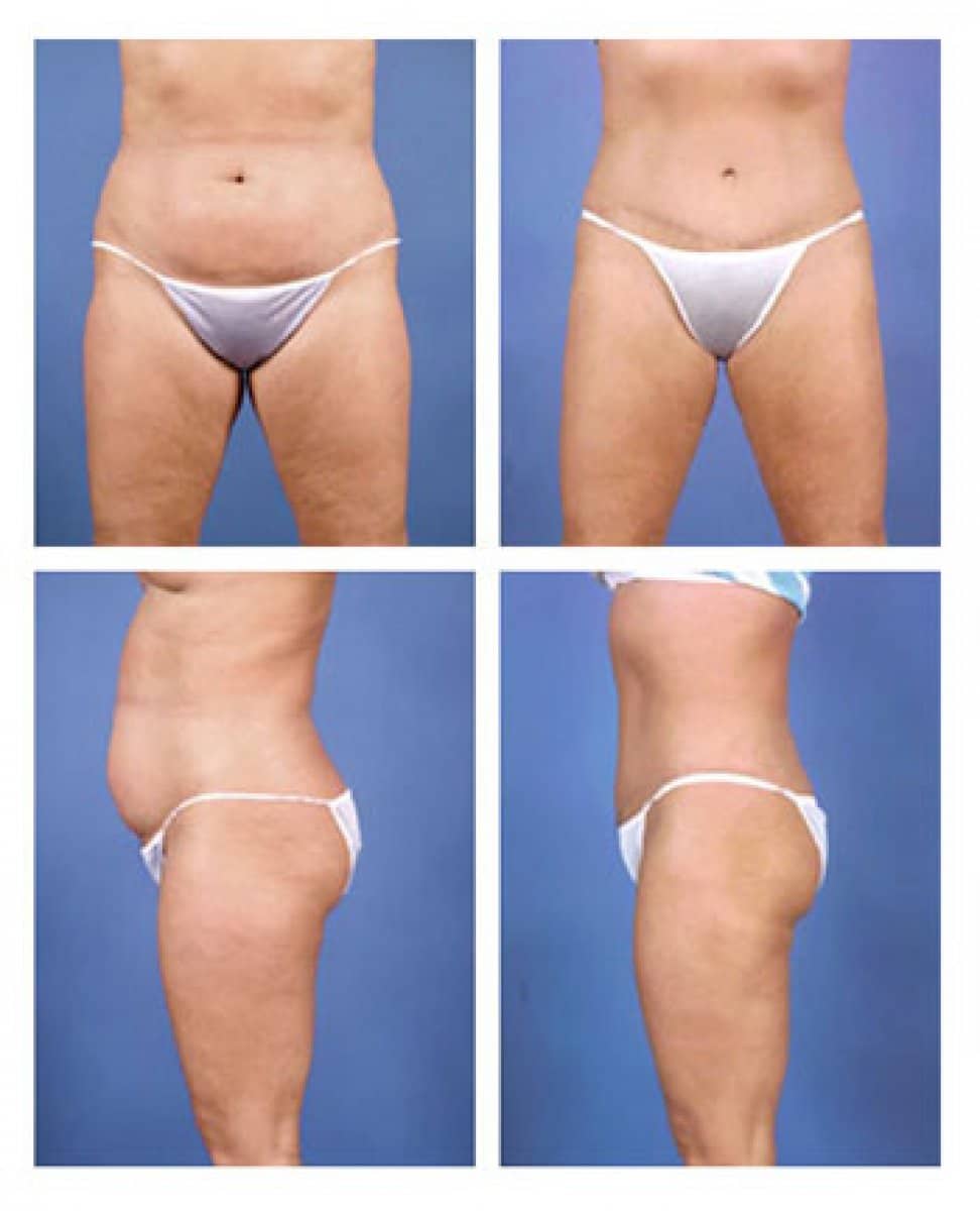 Case 13222 - Body Jet liposuction