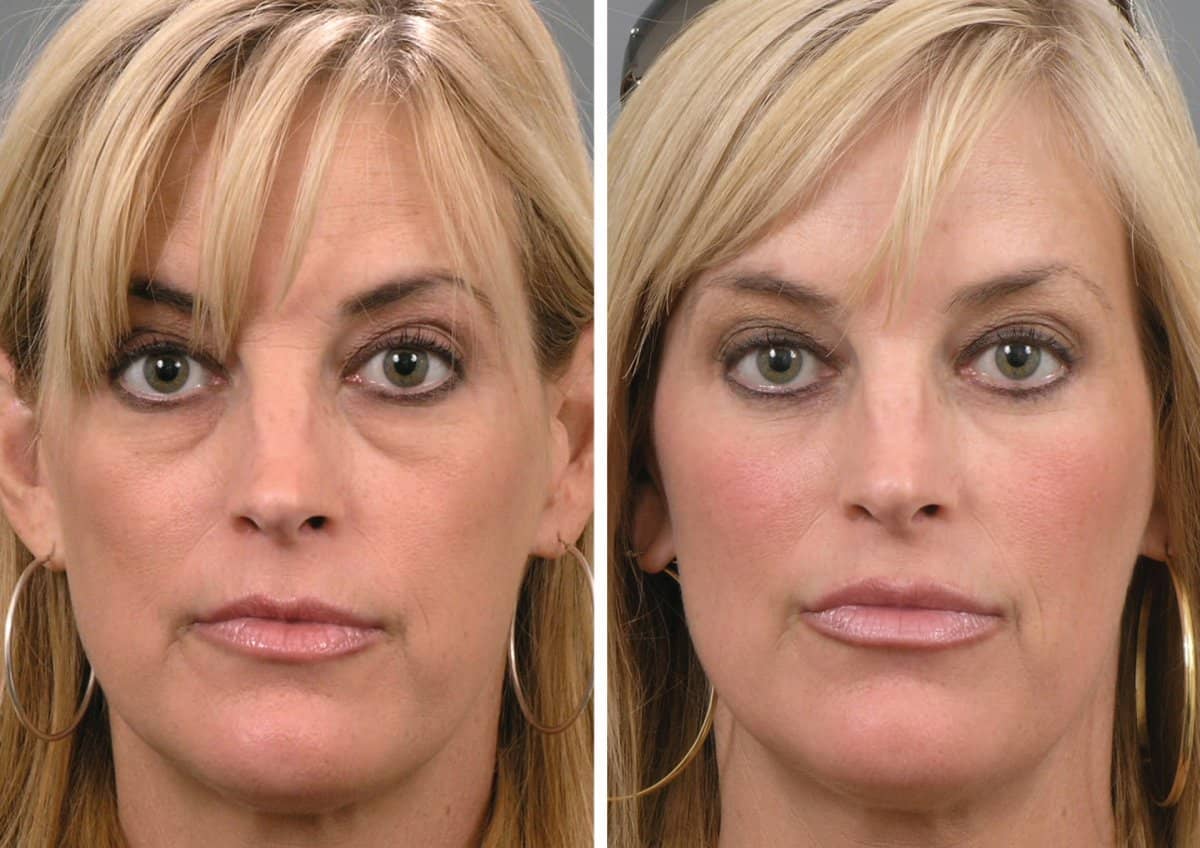 Case 13223 - blepharoplasty