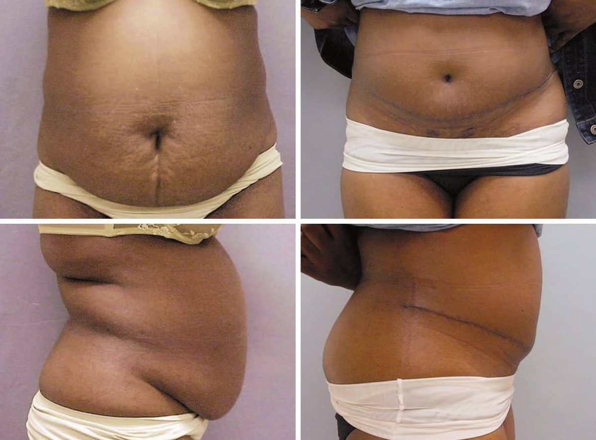 Case 13225 - tummy tuck