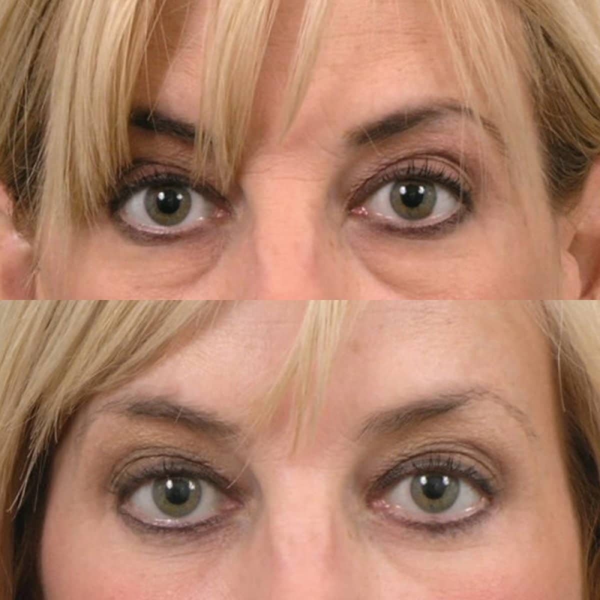 Case 13226 - blepharoplasty