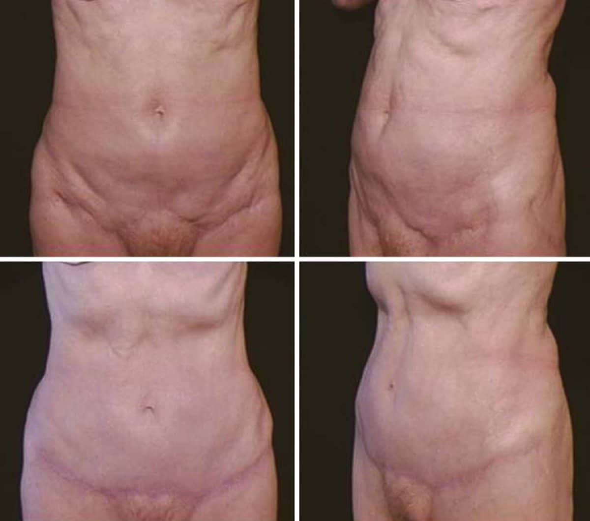 Case 13227 - Body Jet liposuction