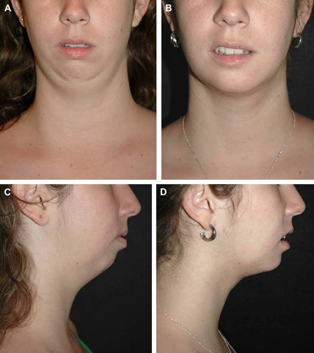 Case 13233 - neck lift