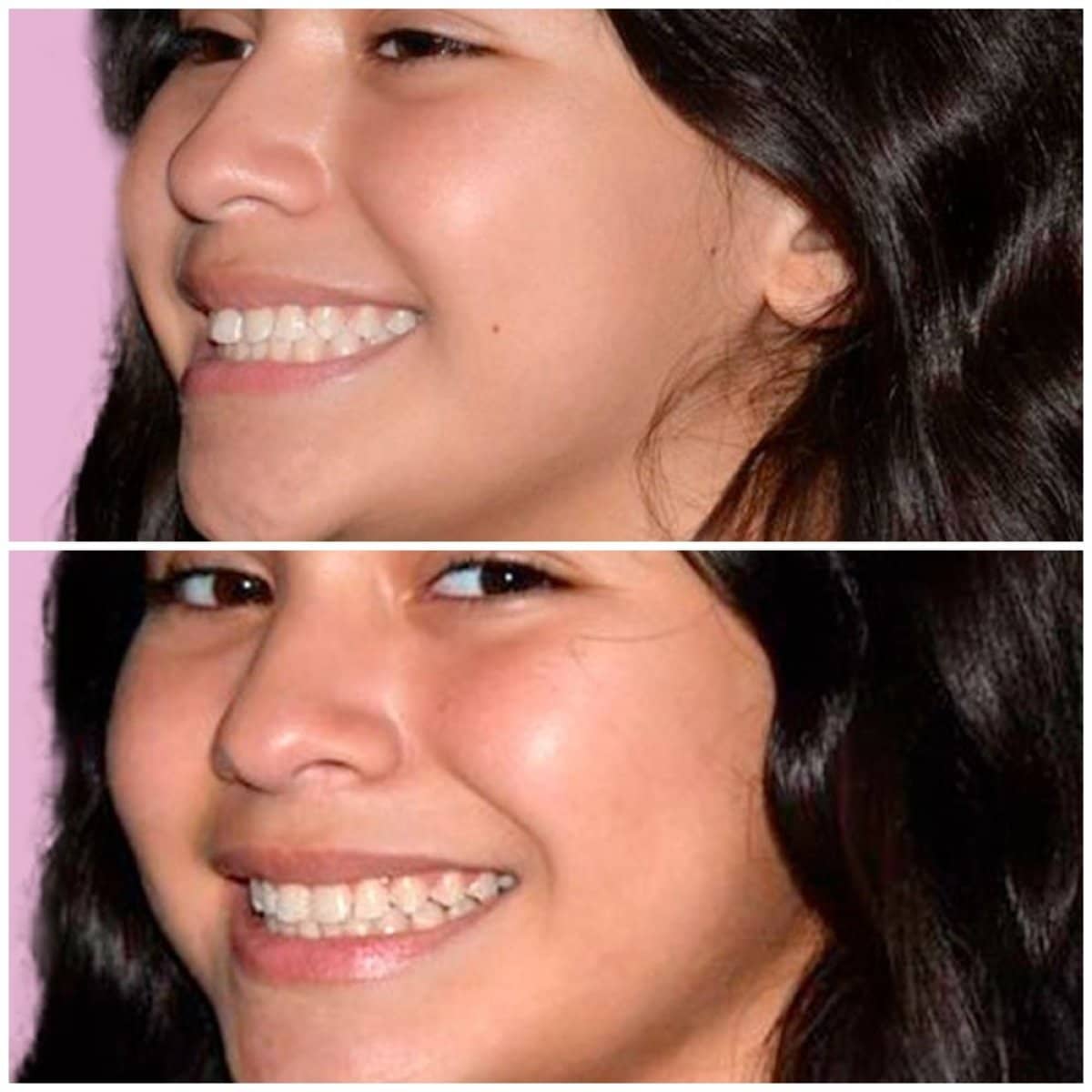 Case 13249 - Invisalign