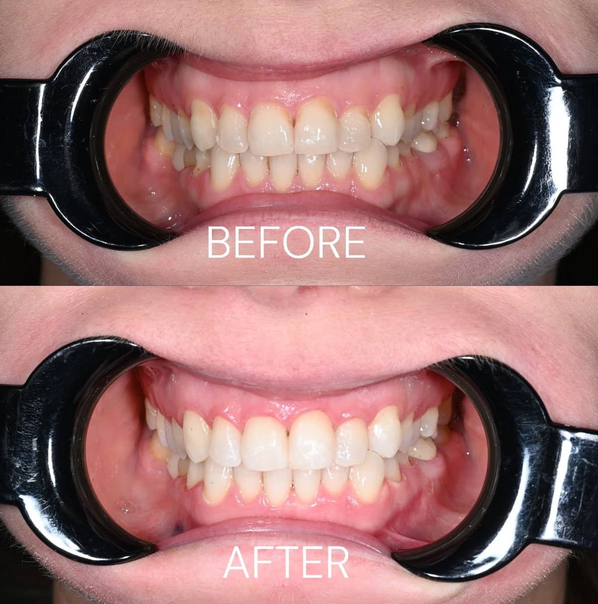 Case 13255 - tooth whitening