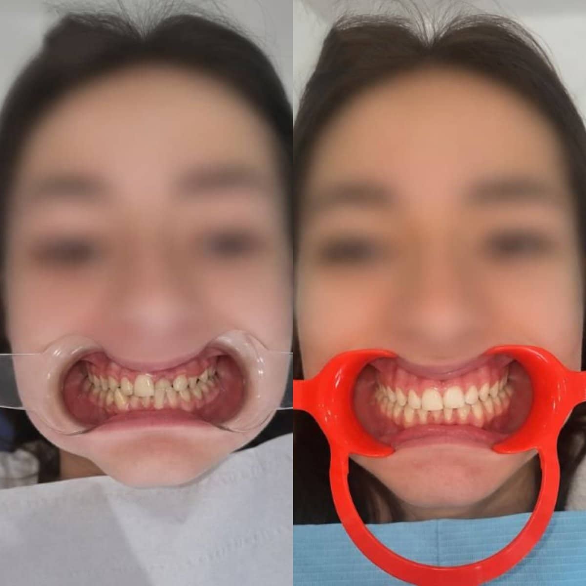 Case 13258 - braces