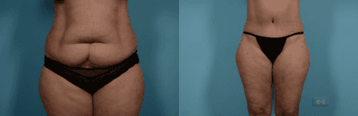 Case 133 - Woman treated with Tummy Tuck