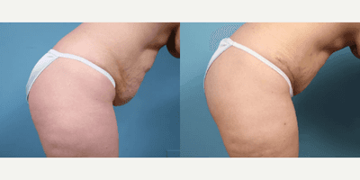 Case 1334 - Woman treated with Tummy Tuck