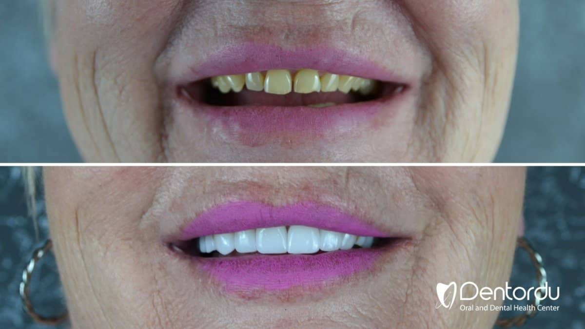 Case 13341 - Hollywood Smile