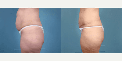 Case 1335 - Woman treated with Tummy Tuck