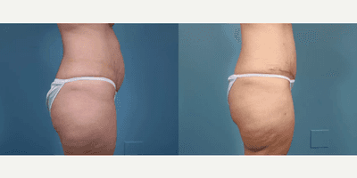 Case 1336 - Woman treated with Tummy Tuck
