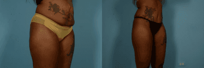 Case 1337 - Woman treated with Tummy Tuck