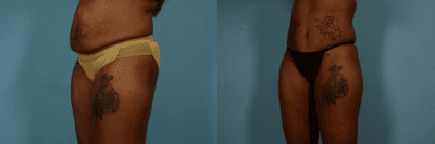 Case 1338 - Woman treated with Tummy Tuck