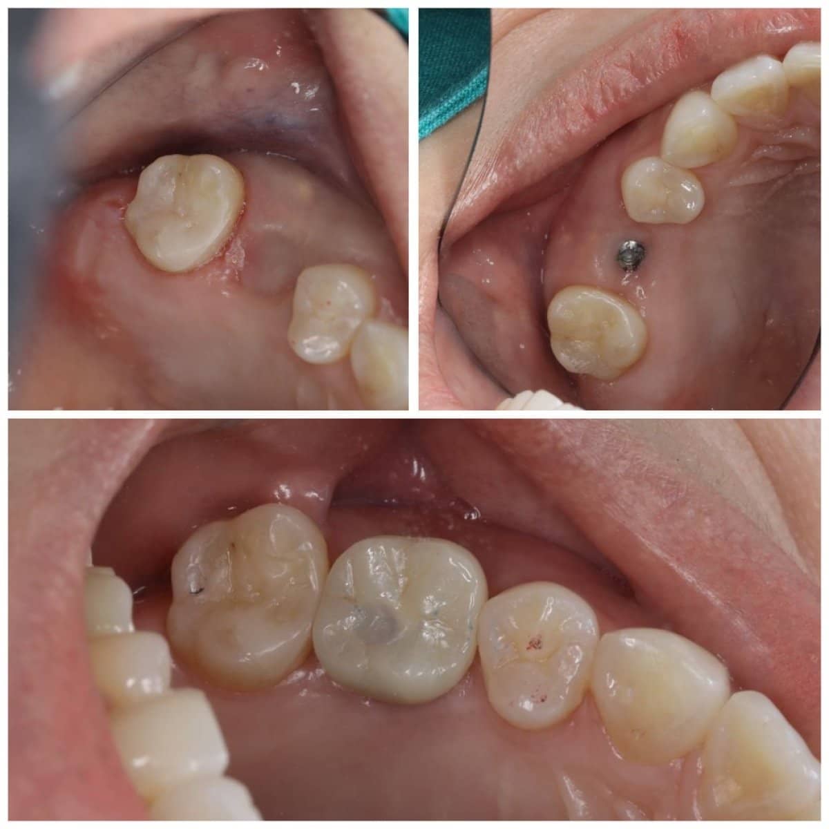 Case 13380 - dental implant with crown