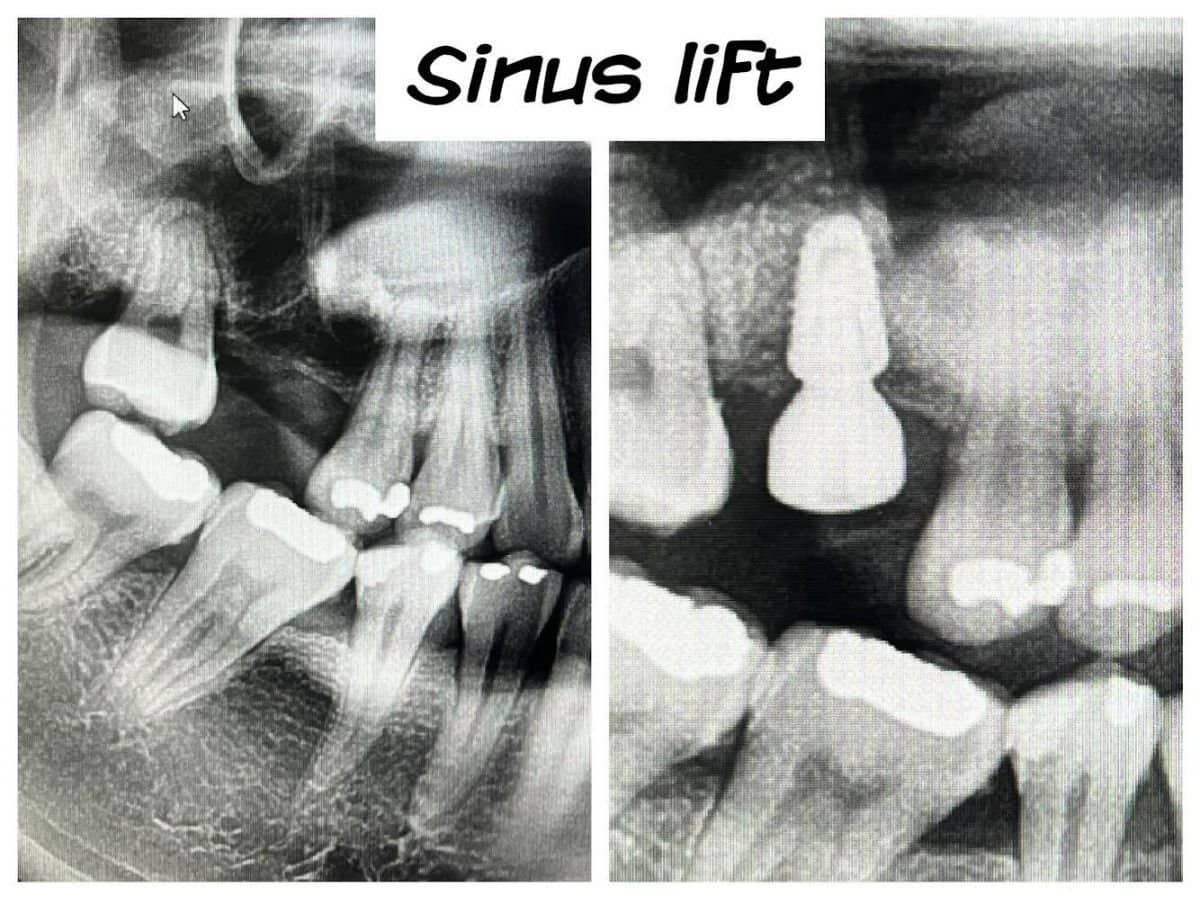 Case 13386 - sinus lift with dental implants