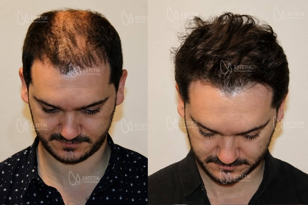Case 13387 - organic hair transplantation