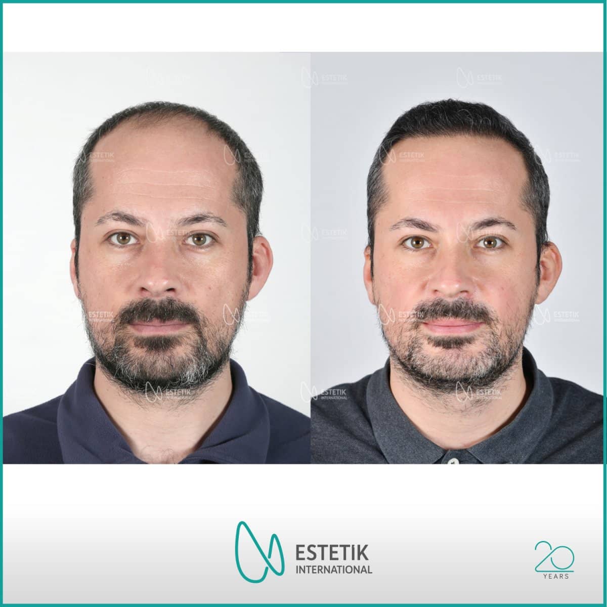 Case 13388 - organic hair transplantation