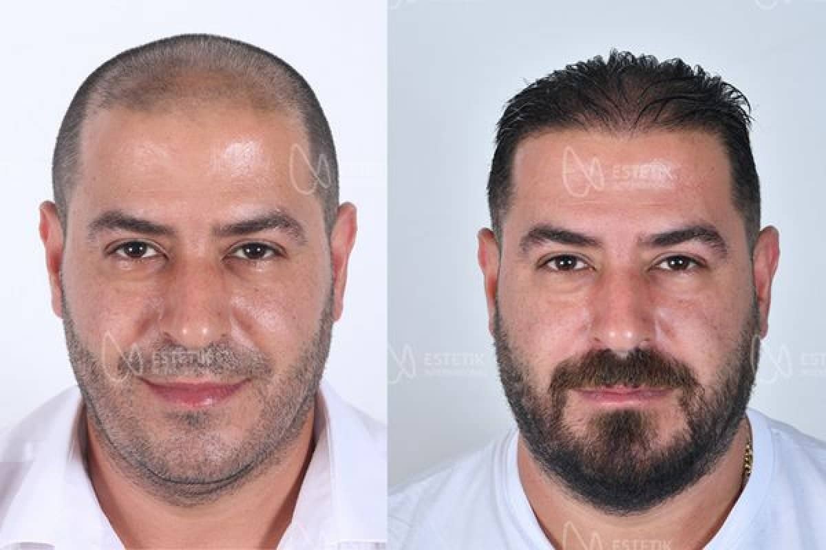 Case 13389 - organic hair transplantation