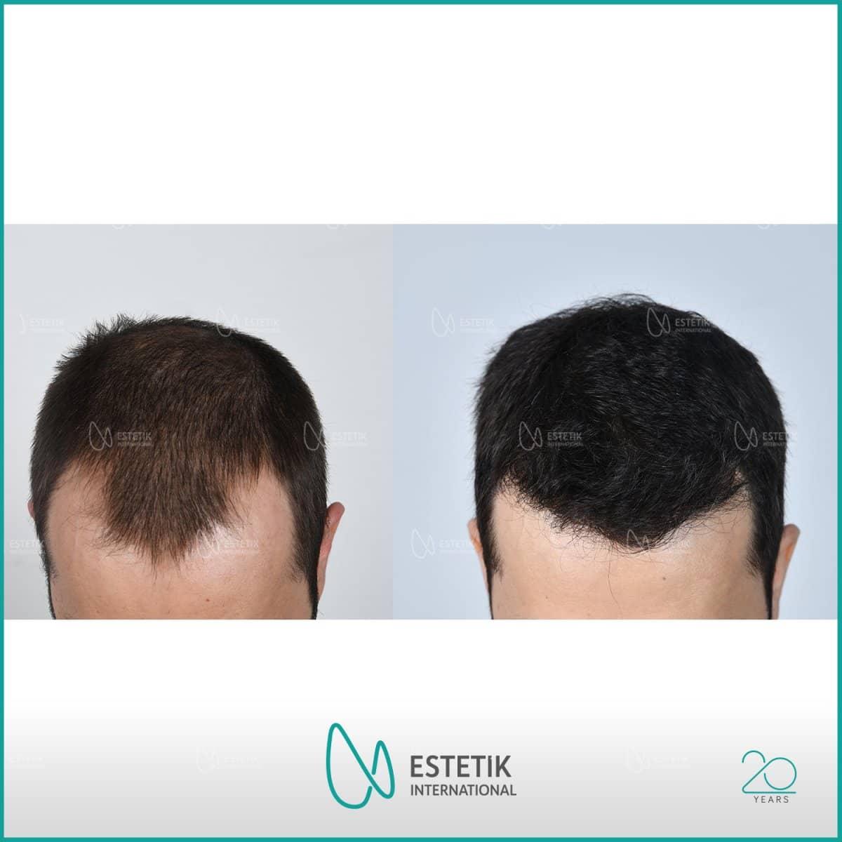 Case 13390 - hair transplant