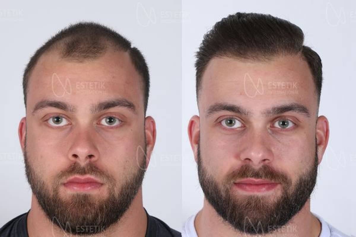 Case 13391 - organic hair transplantation