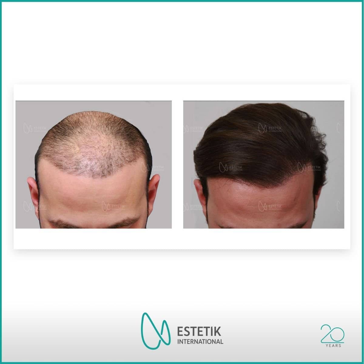Case 13392 - FUE hair transplant