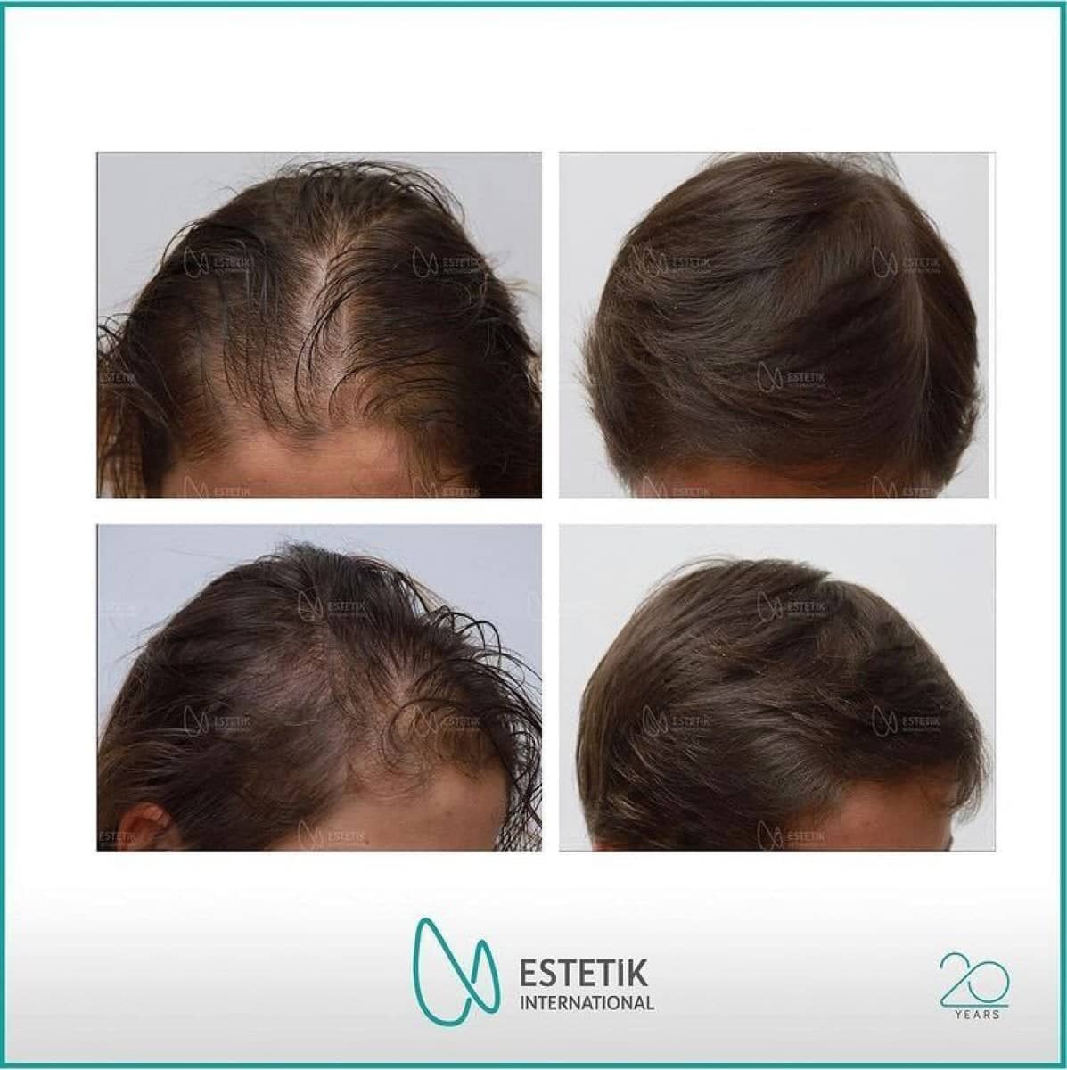 Case 13394 - FUE hair transplant
