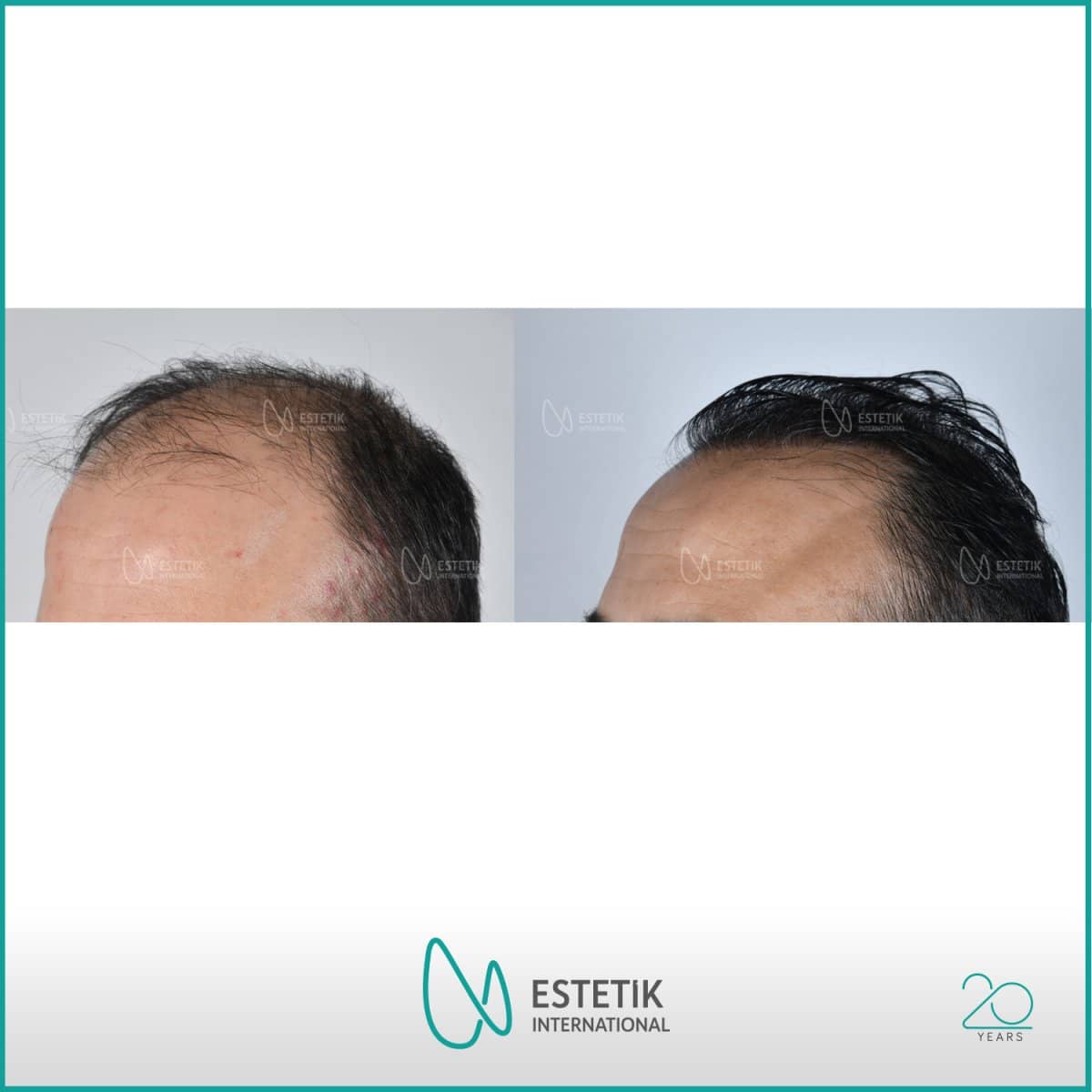Case 13395 - hair transplant
