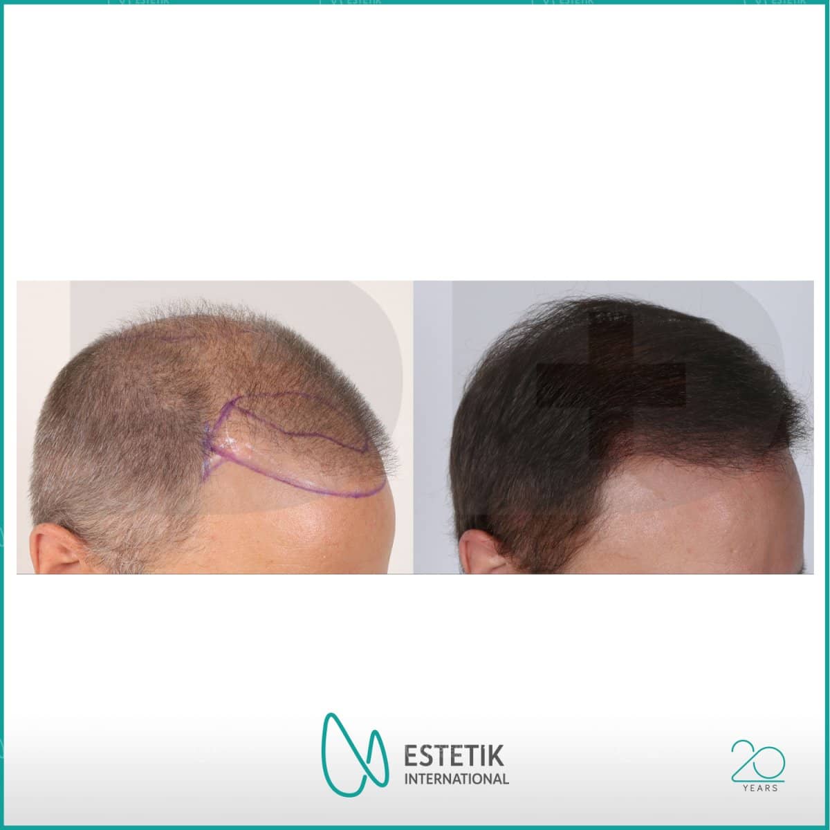 Case 13396 - hair transplant