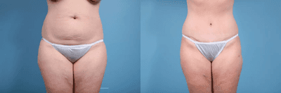 Case 134 - Woman treated with Tummy Tuck