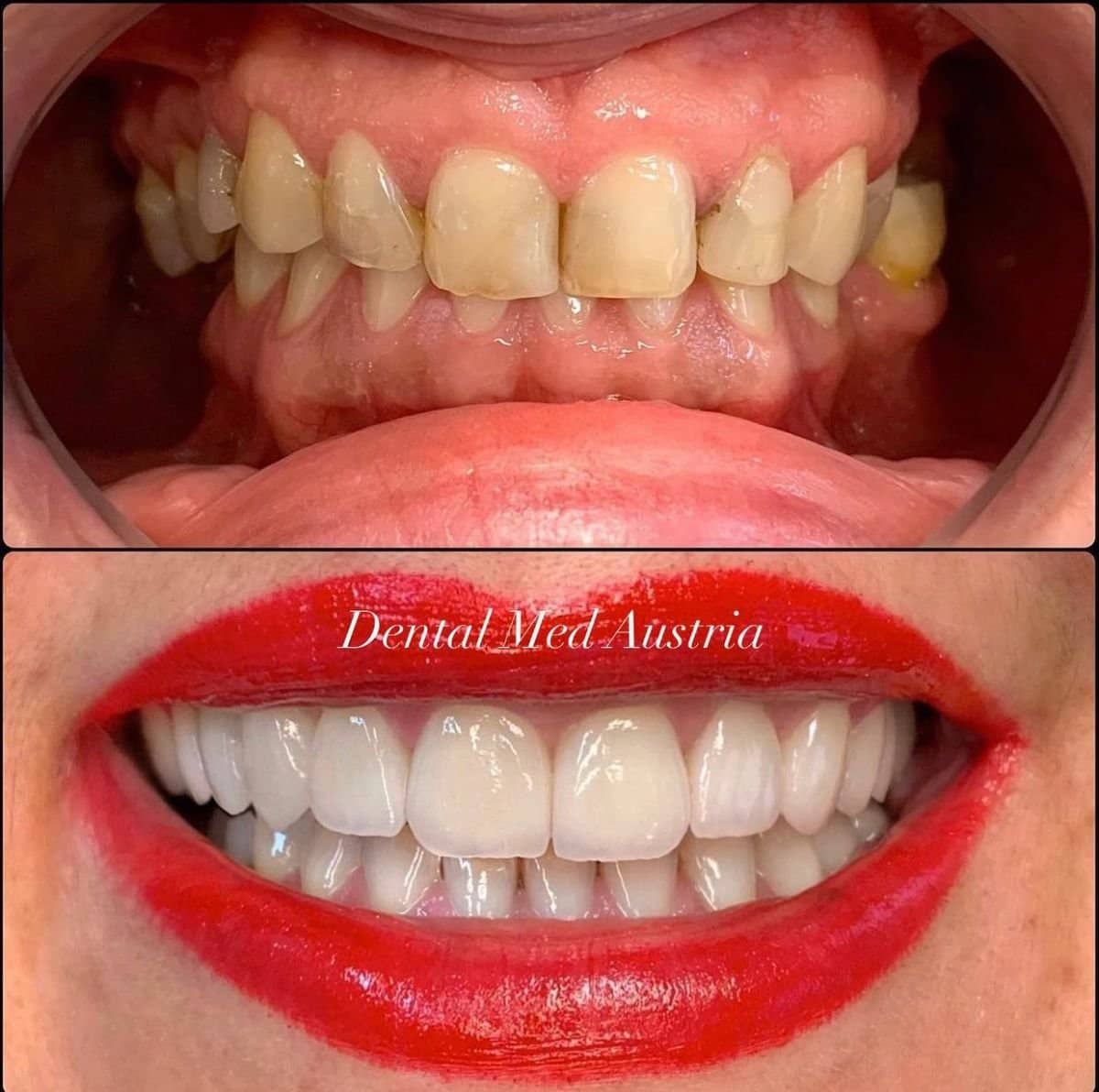 Case 13400 - Hollywood Smile veneers