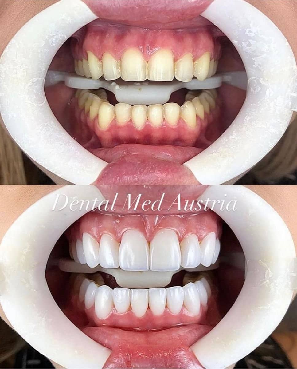 Case 13401 - Hollywood Smile veneers