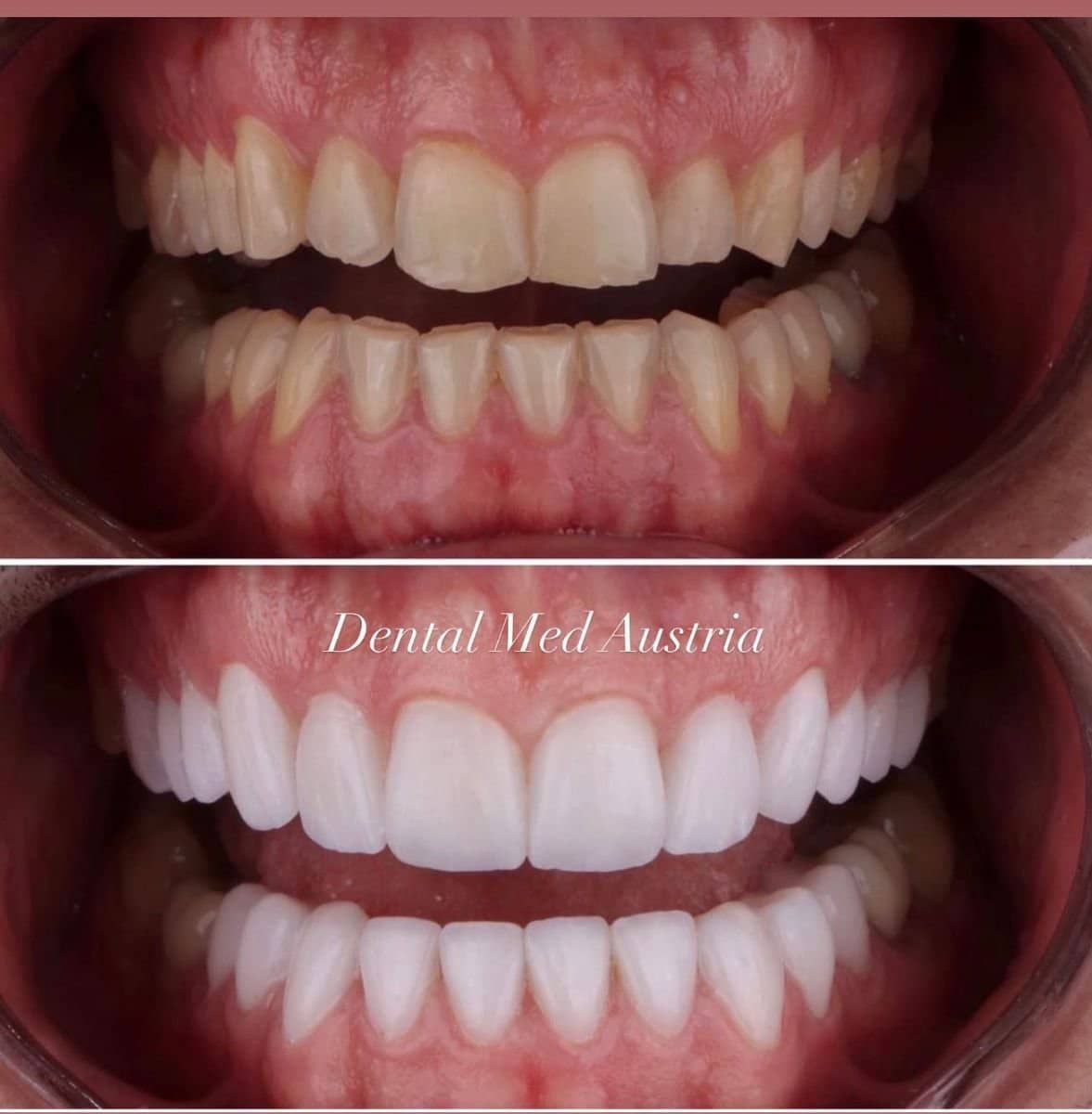 Case 13403 - Hollywood Smile veneers