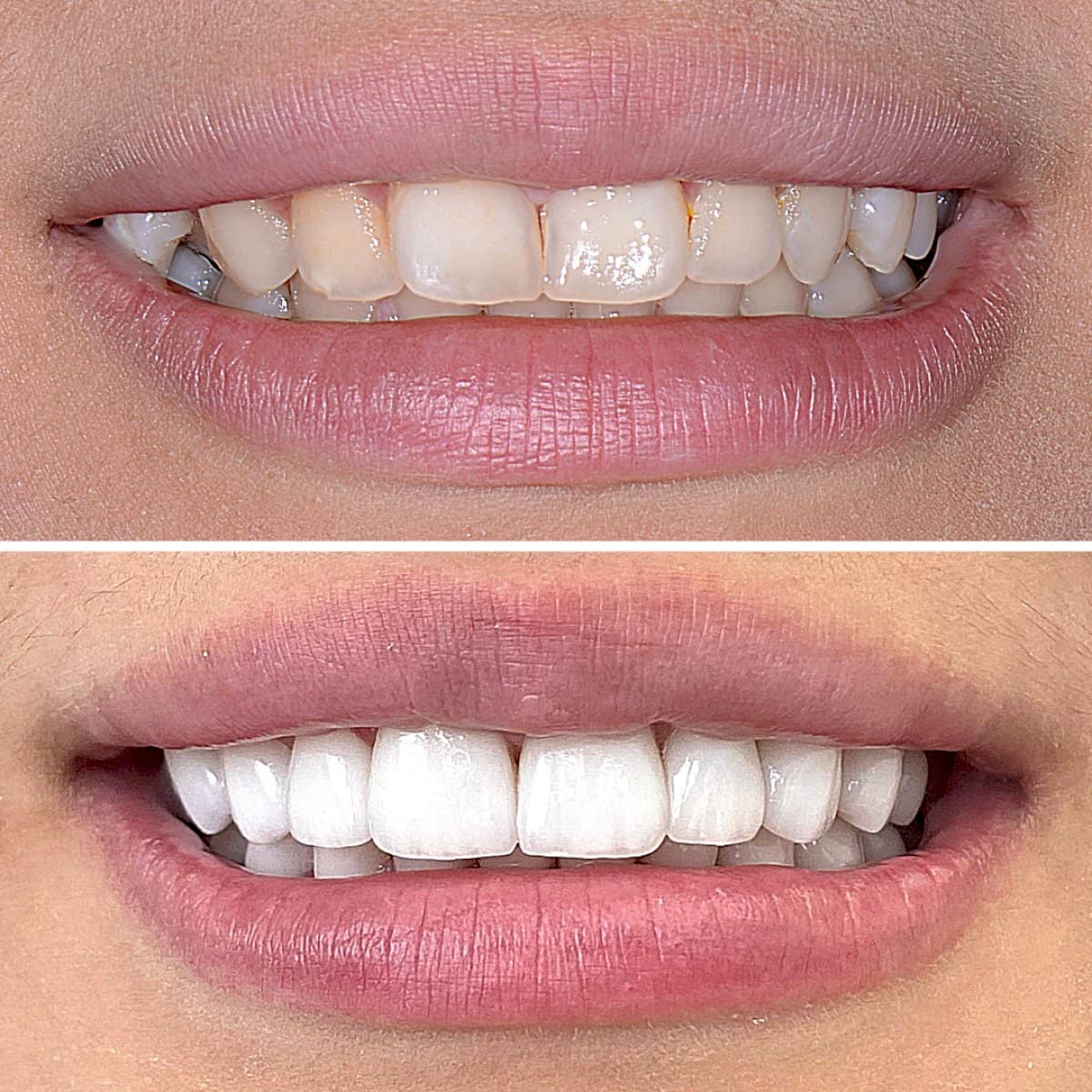Case 13429 - denture