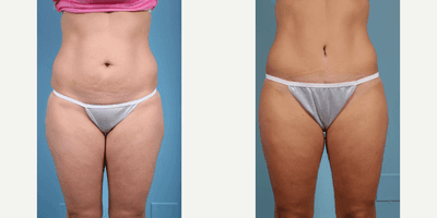 Case 135 - Woman treated with Tummy Tuck