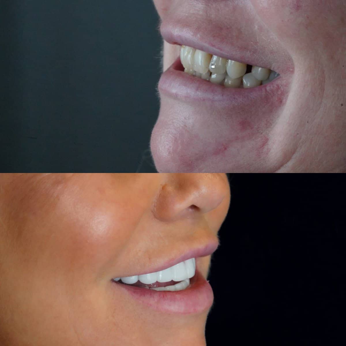 Case 13507 - zirconia dental bridge