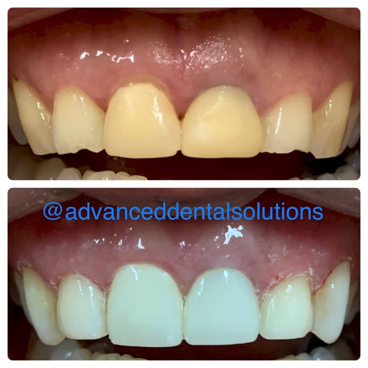 Case 13556 - composite veneer
