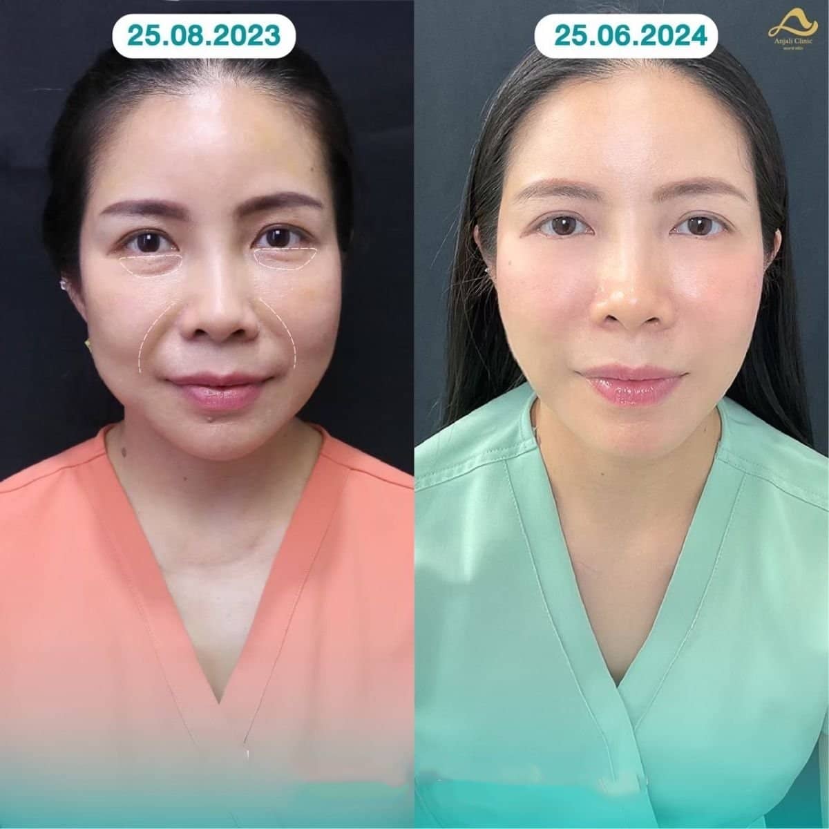 Case 13573 - nonsurgical facelift
