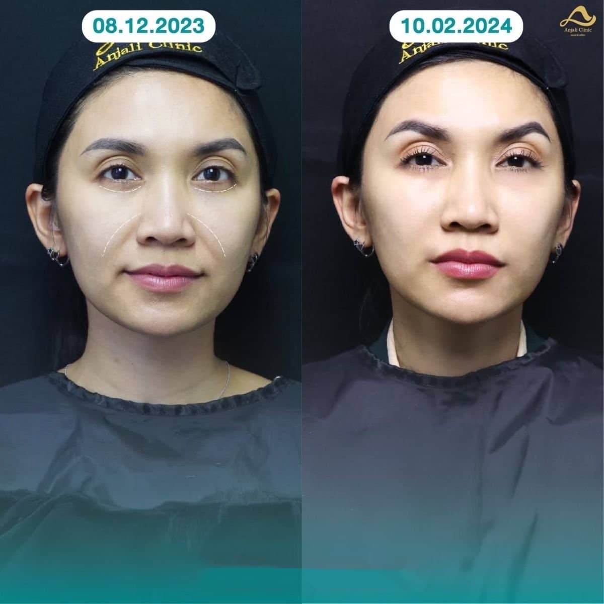 Case 13575 - nonsurgical facelift
