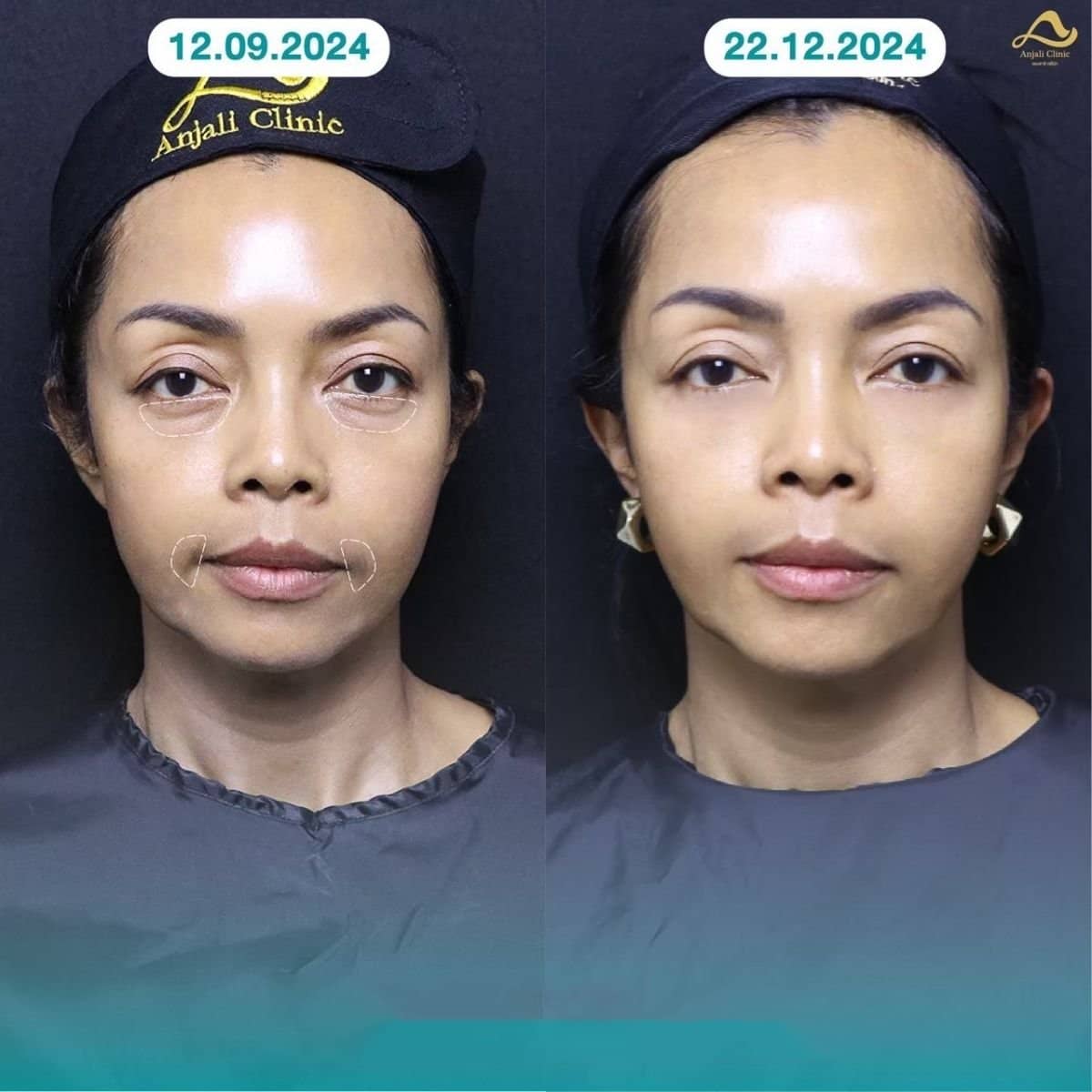 Case 13576 - nonsurgical facelift