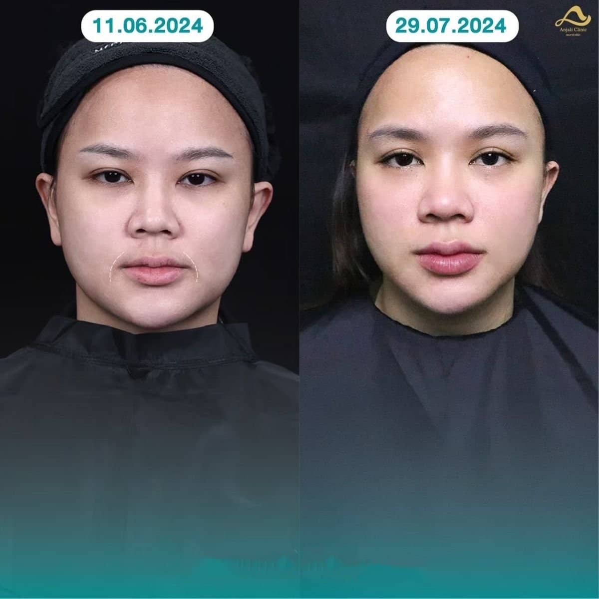 Case 13577 - nonsurgical facelift