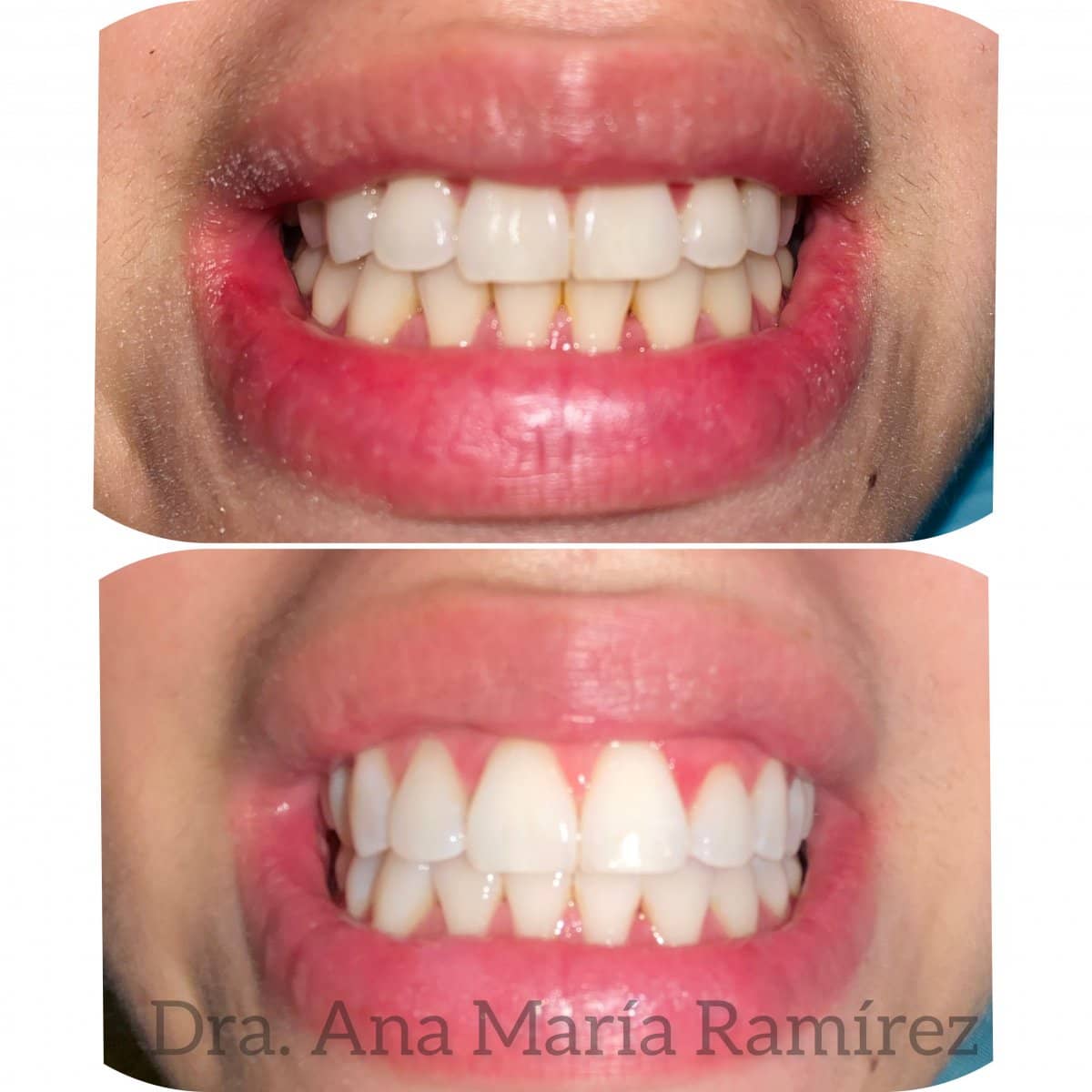 Case 13581 - tooth whitening