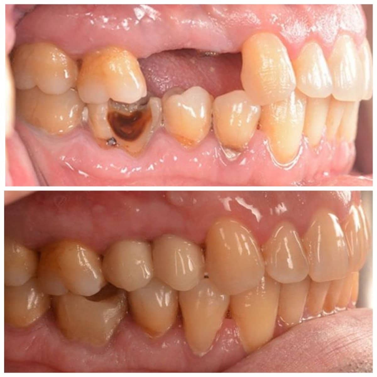 Case 13585 - dental implant with crown