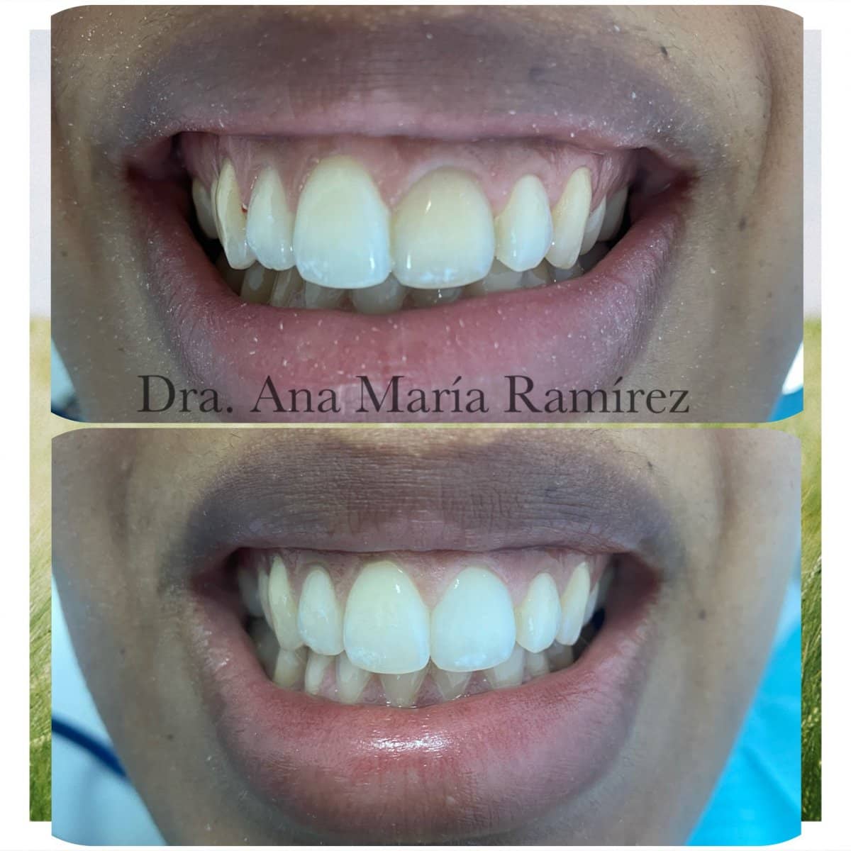 Case 13586 - tooth whitening