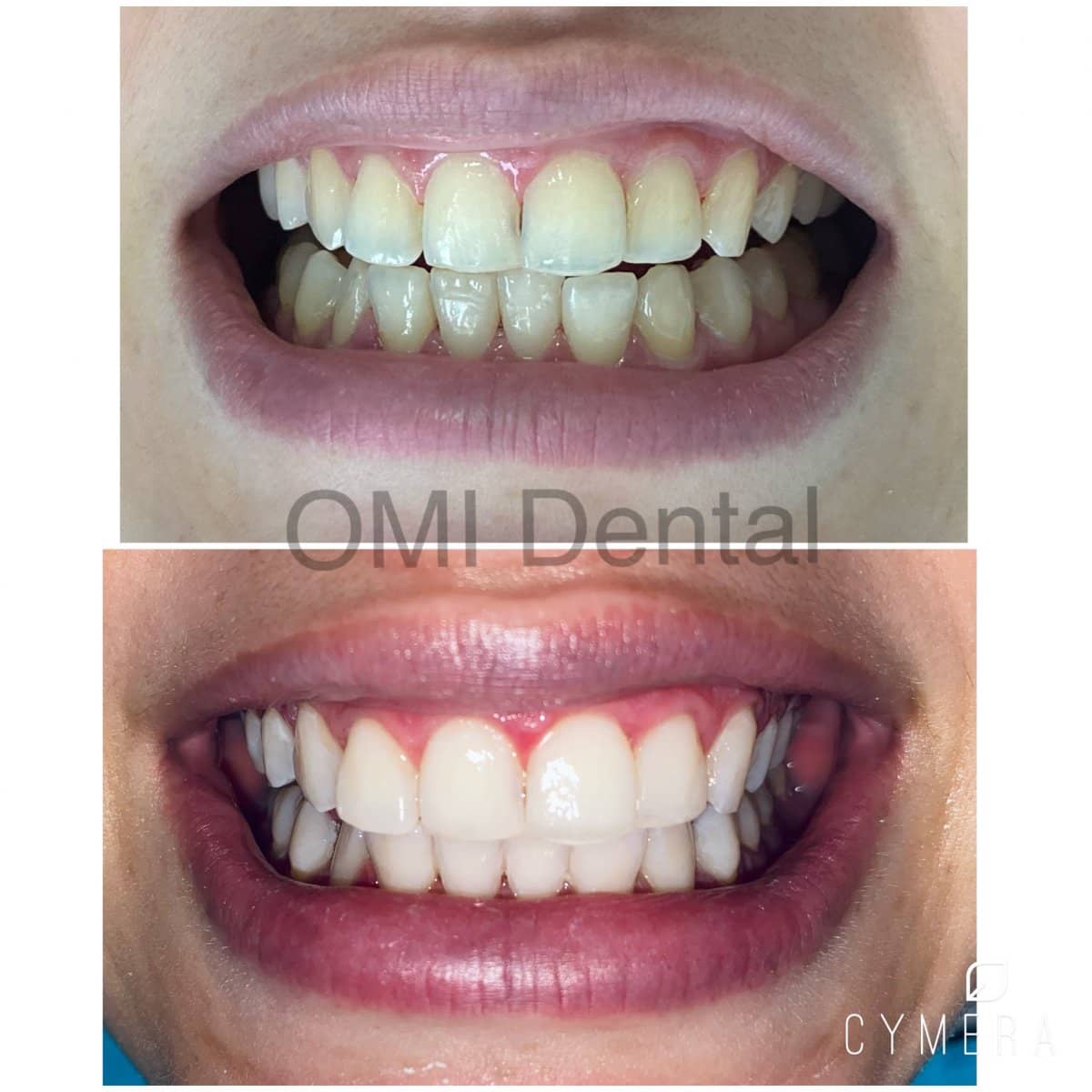 Case 13589 - tooth whitening