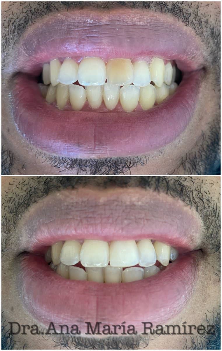 Case 13590 - tooth whitening
