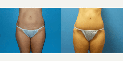 Case 136 - Woman treated with Tummy Tuck