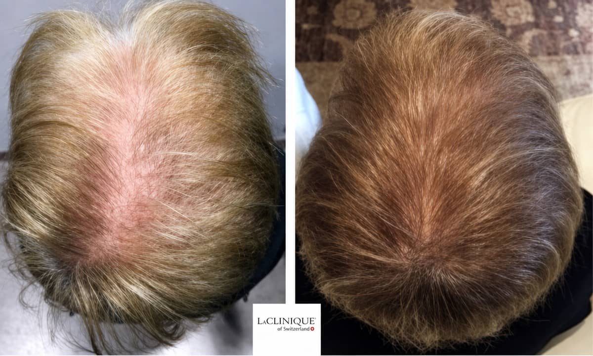 Case 13619 - hair mesotherapy