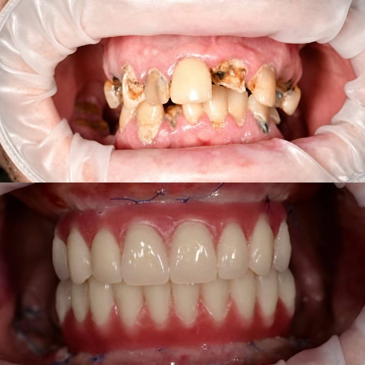 Case 13625 - dental prosthetics installation